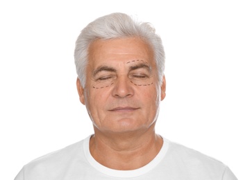 Photo of Portrait of senior man with marks on face preparing for cosmetic surgery against white background