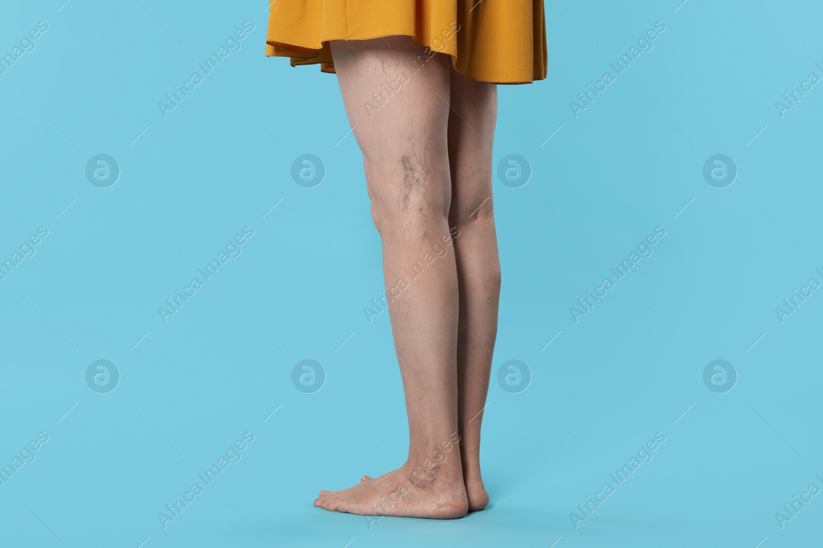 Photo of Closeup view of woman with varicose veins on light blue background