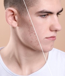 Acne problem, collage. Photo of man divided into halves before and after treatment on beige background