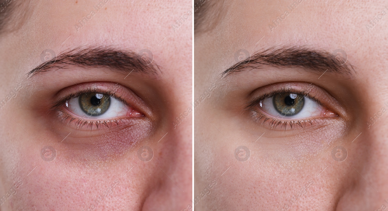 Image of Collage with photos of woman with dark circle under eye before and after treatment, closeup