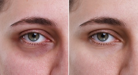 Image of Collage with photos of woman with dark circle under eye before and after treatment, closeup