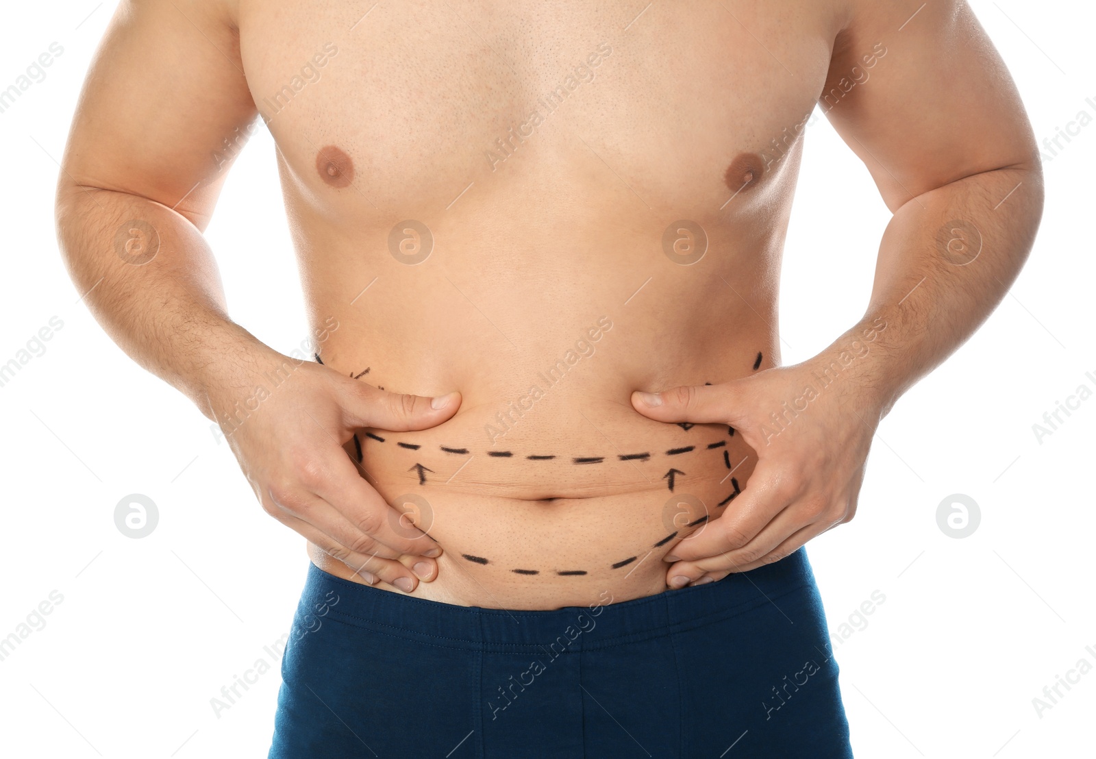 Photo of Young man with marks on belly for cosmetic surgery operation against white background, closeup