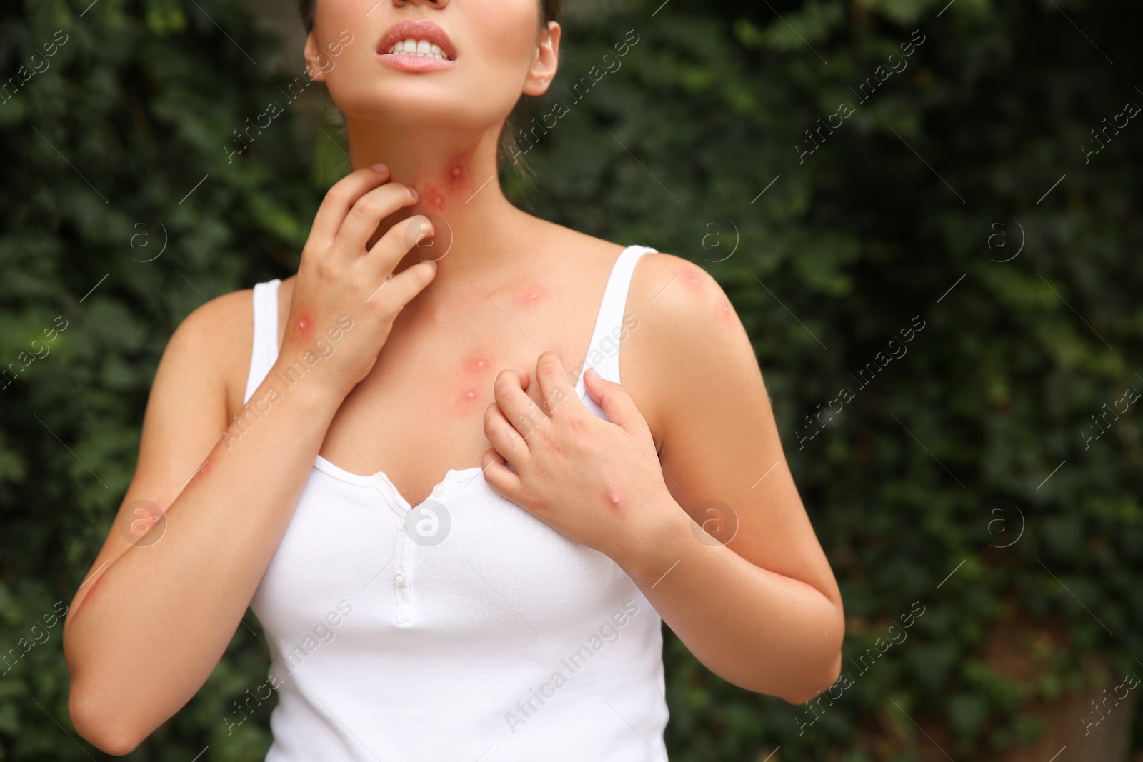 Photo of Woman scratching neck with insect bites in park, closeup