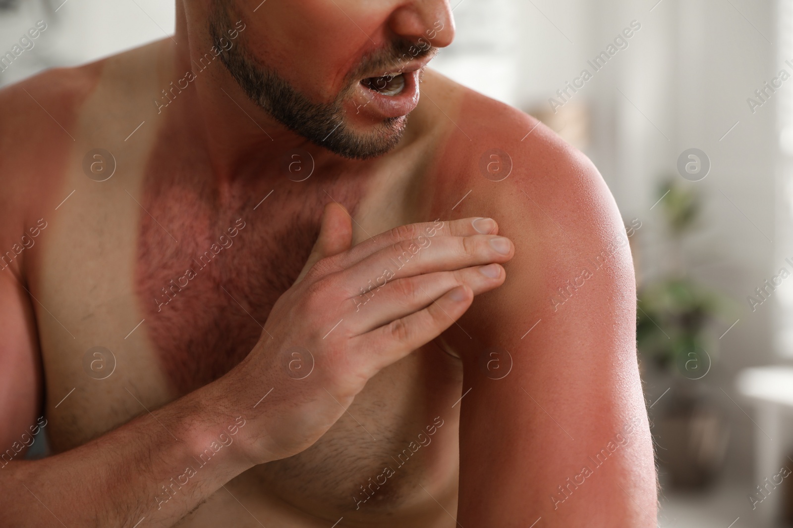 Photo of Man with sunburned skin at home, closeup