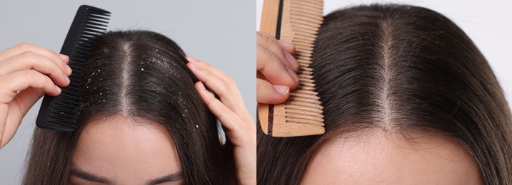 Woman showing hair before and after dandruff treatment on color backgrounds, collage