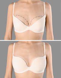 Woman before and after breast augmentation on light grey background, closeup
