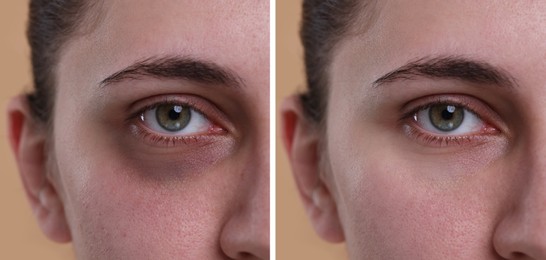 Image of Collage with photos of woman with dark circle under eye before and after treatment on beige background, closeup
