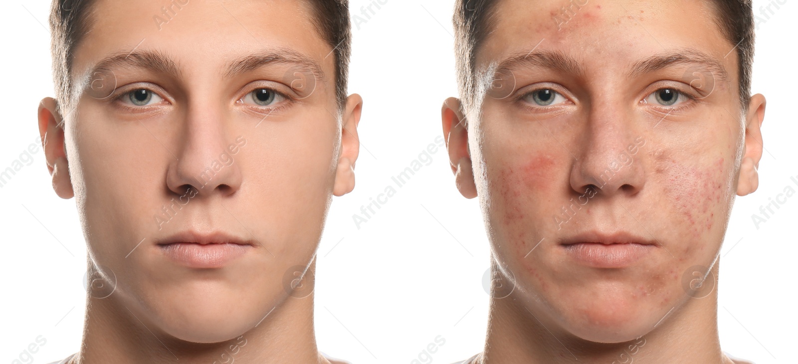 Image of Collage with photos of teen guy with acne problem before and after treatment on white background. Banner design