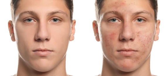 Collage with photos of teen guy with acne problem before and after treatment on white background. Banner design