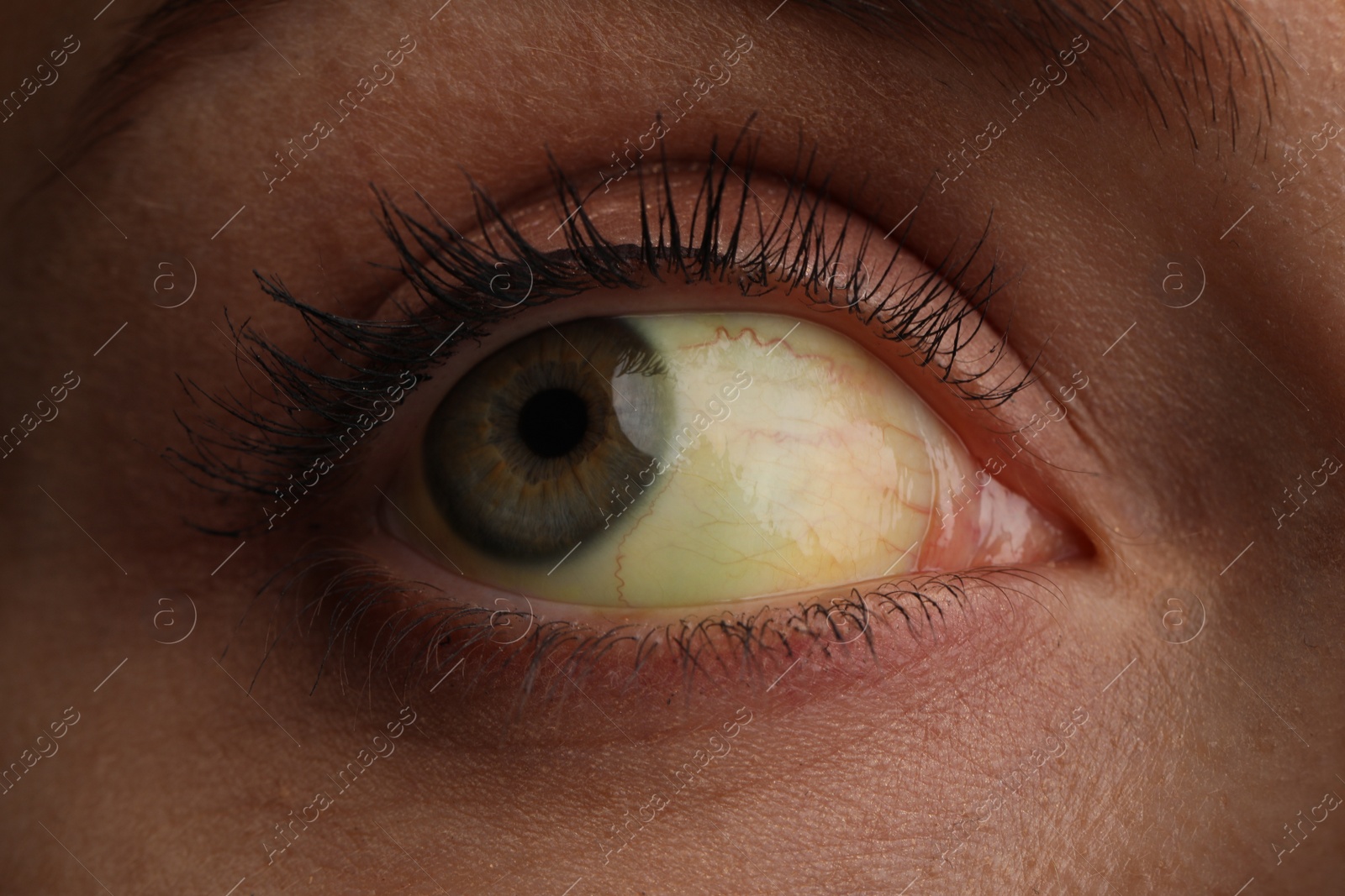 Photo of Woman with yellow eyes, closeup. Liver problems symptom