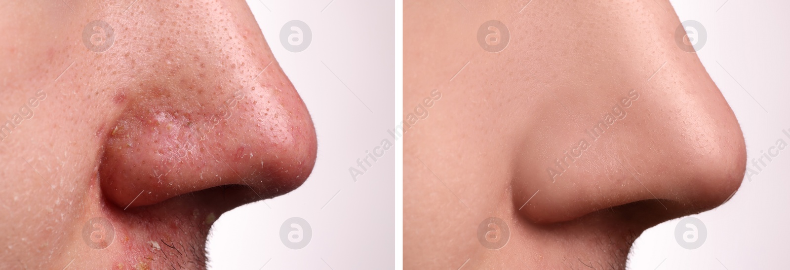 Image of Before and after acne treatment. Photos of man on white background, closeup. Collage showing affected and healthy skin