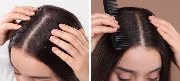 Woman showing hair before and after dandruff treatment on color backgrounds, collage