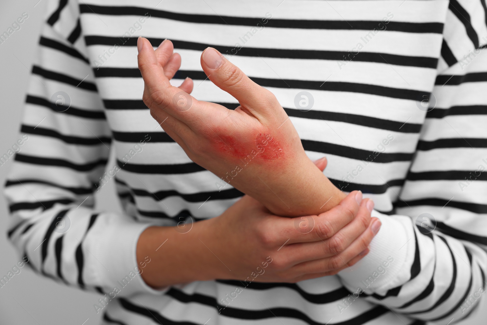 Photo of Woman with burn on her hand, closeup