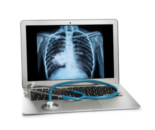 Image of Laptop with x-ray of lung cancer patient on white background