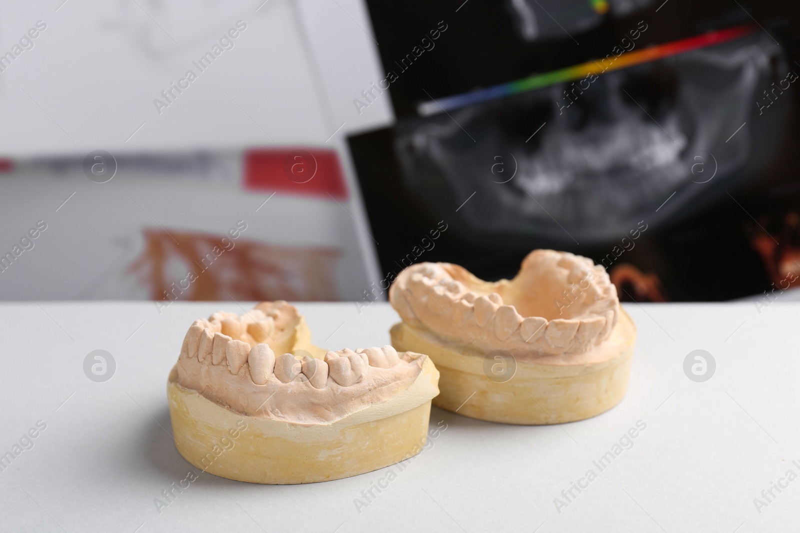 Photo of Dental model with gums on white table against panoramic x-ray. Cast of teeth