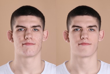 Acne problem. Young man before and after treatment on beige background, collage of photos