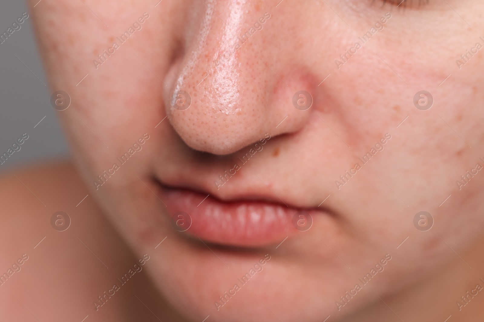 Photo of Closeup view of woman with comedones on her nose