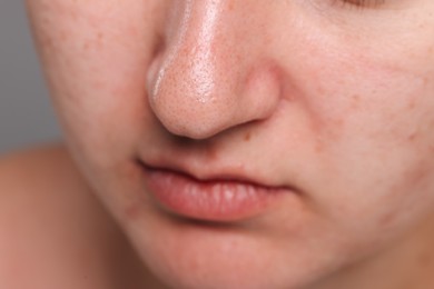 Closeup view of woman with comedones on her nose