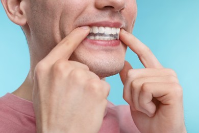 Young man applying whitening strip on his teeth against light blue background, closeup