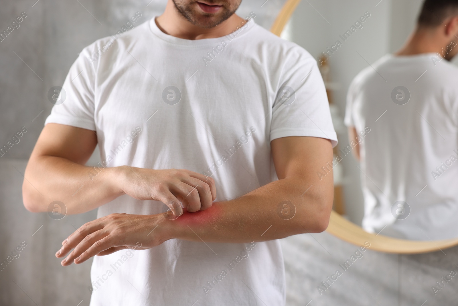 Photo of Man suffering from allergy scratching his hand indoors, closeup