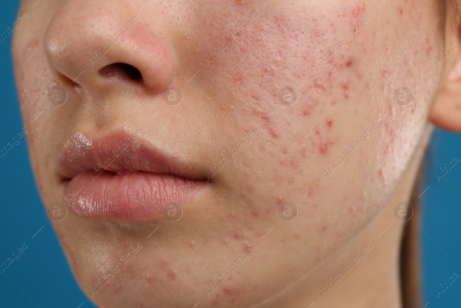 Photo of Teenage girl with acne problem on blue background, closeup