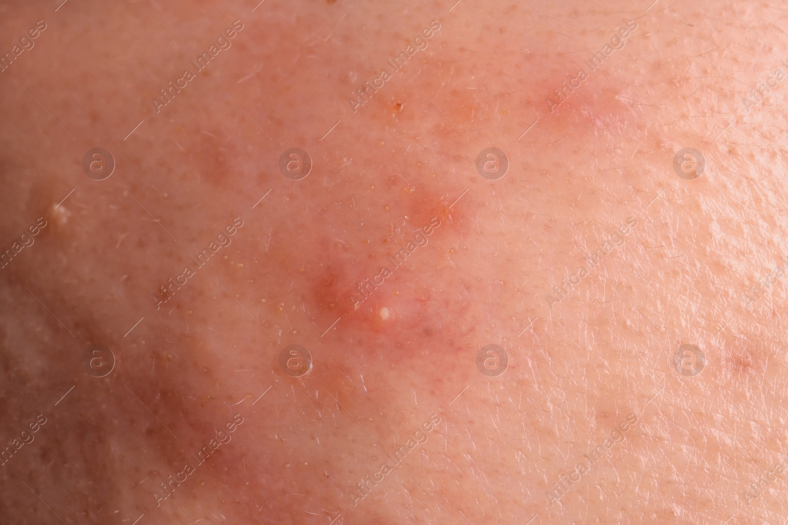 Photo of Young person with acne problem, closeup view of skin