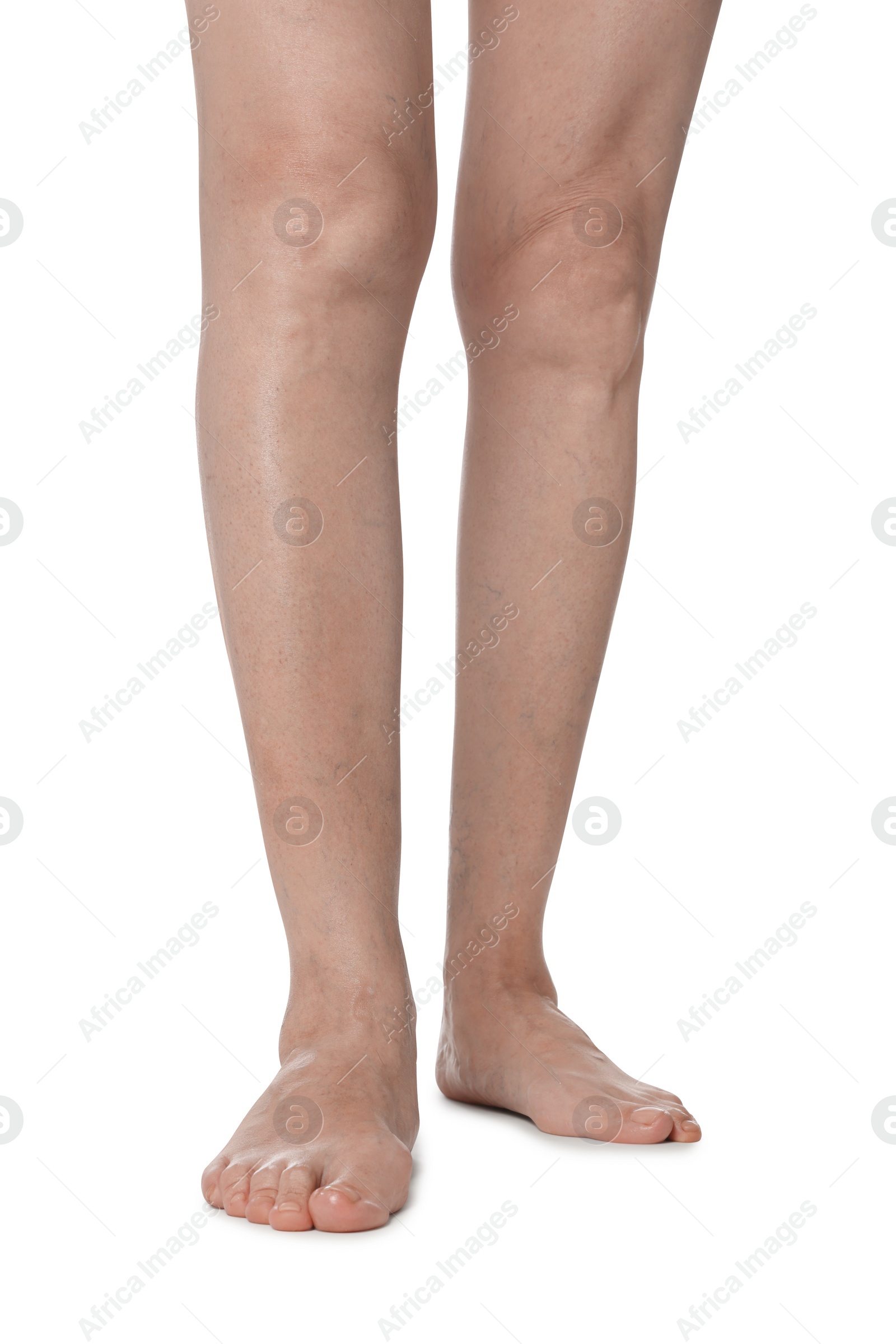 Photo of Closeup view of woman with varicose veins on white background