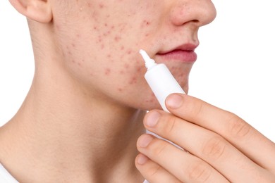 Young man with acne problem applying cosmetic product onto his skin on white background, closeup