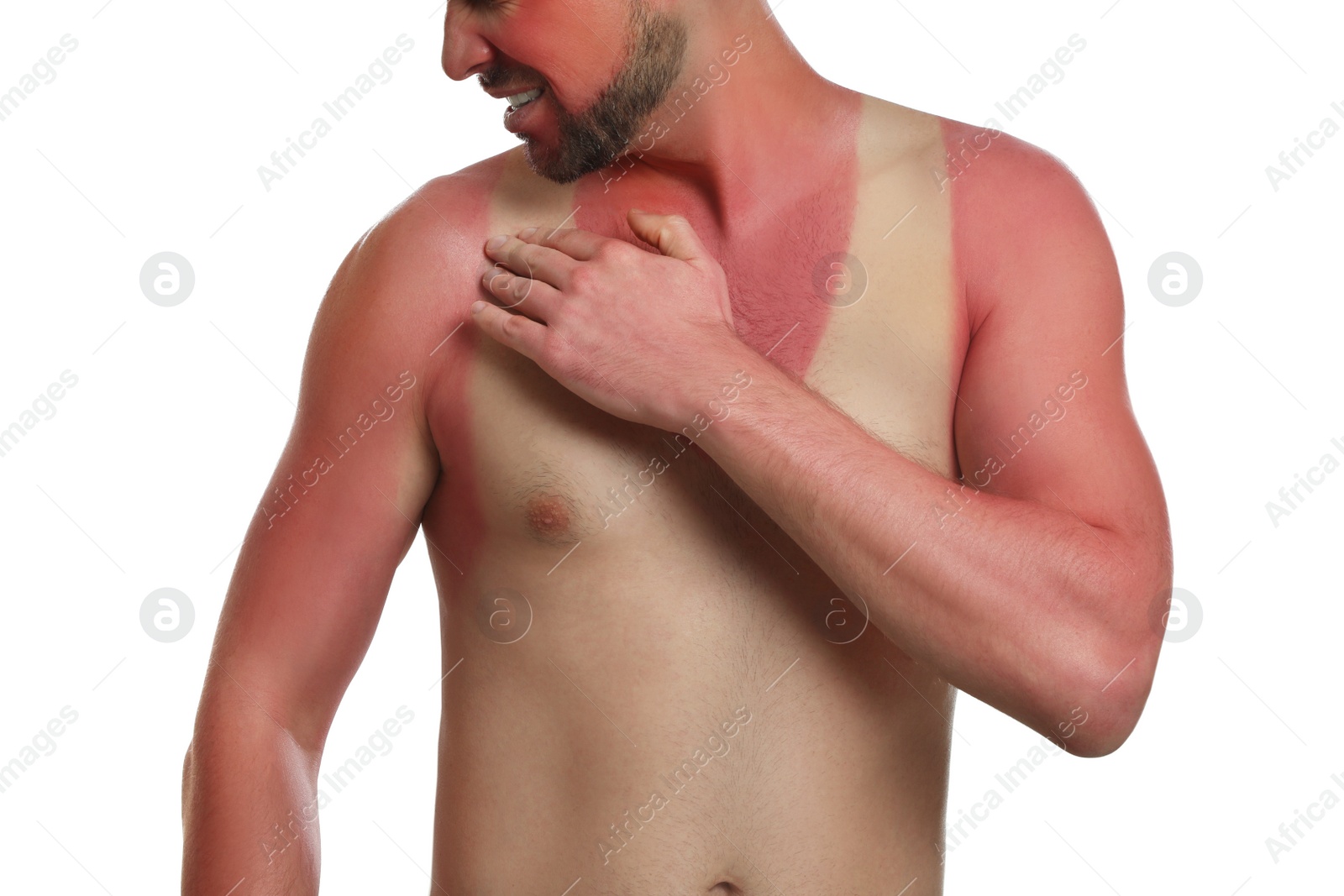 Photo of Man with sunburned skin on white background, closeup