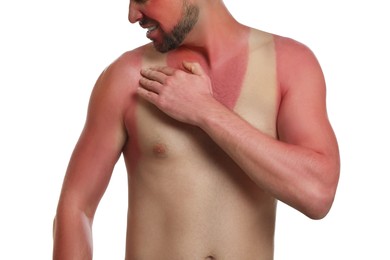 Man with sunburned skin on white background, closeup