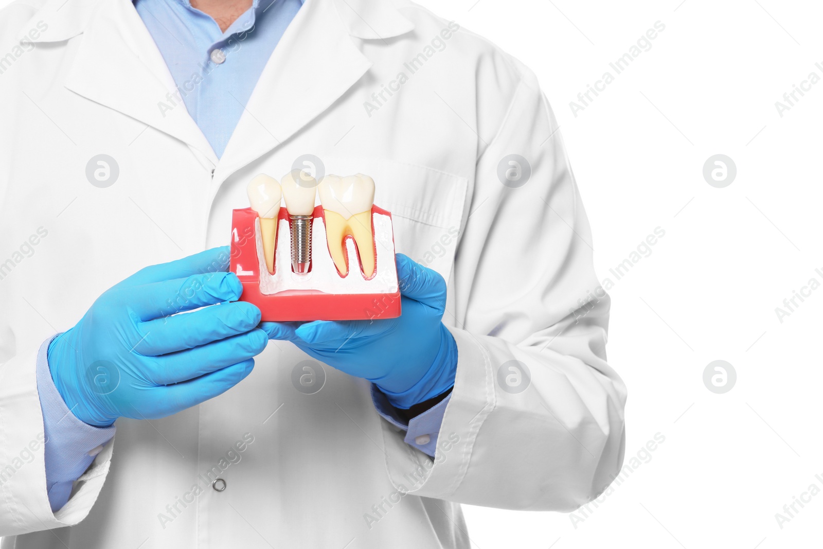 Photo of Dentist holding educational model of dental implant on white background, closeup