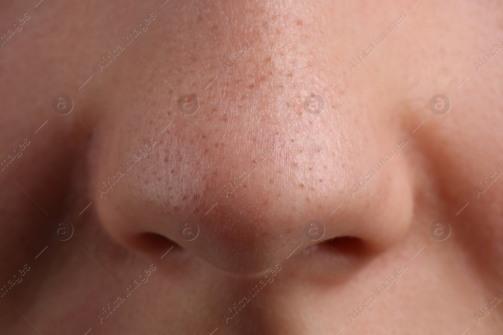 Photo of Young woman with acne problem, closeup view of nose