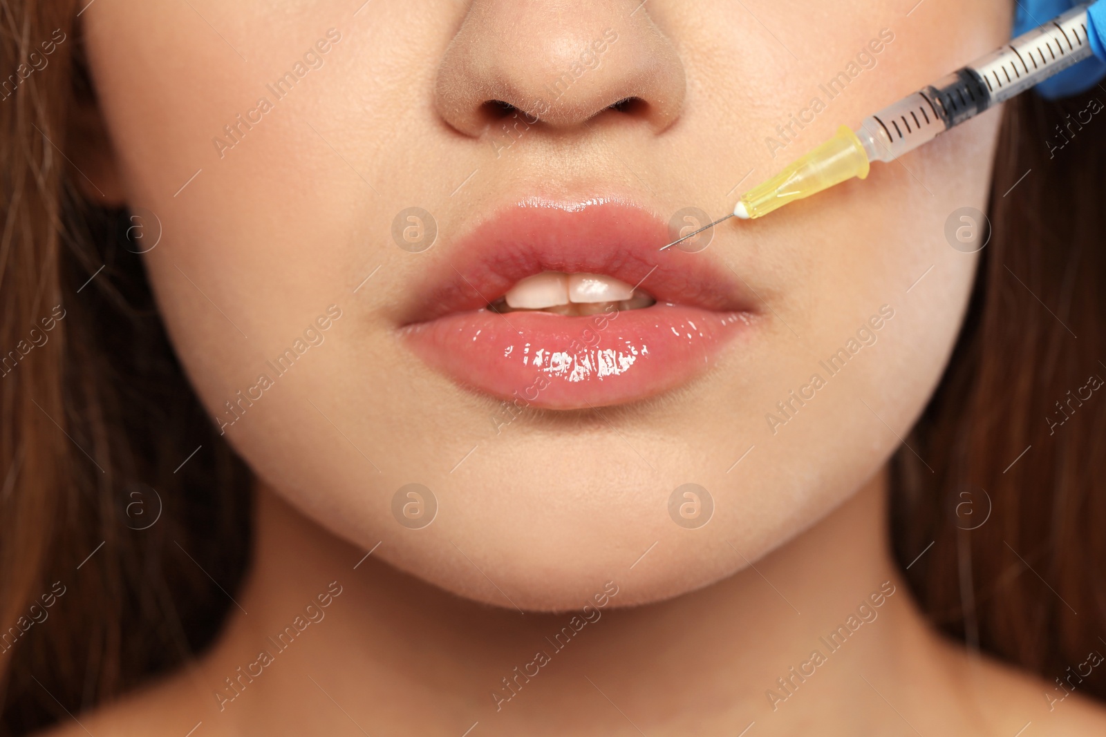 Photo of Young woman getting lips injection, closeup. Cosmetic surgery