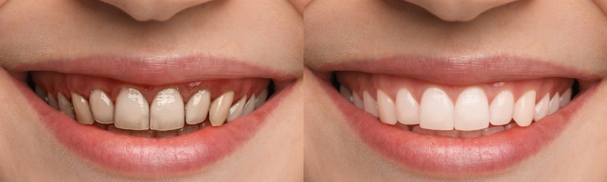 Image of Collage with photos of young woman before and after dental treatment, closeup. Banner design