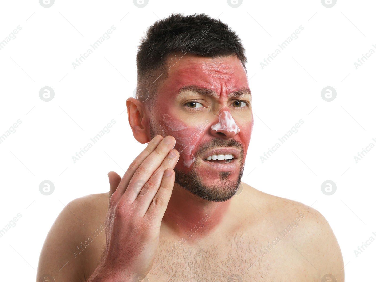 Photo of Man applying cream on sunburn against white background