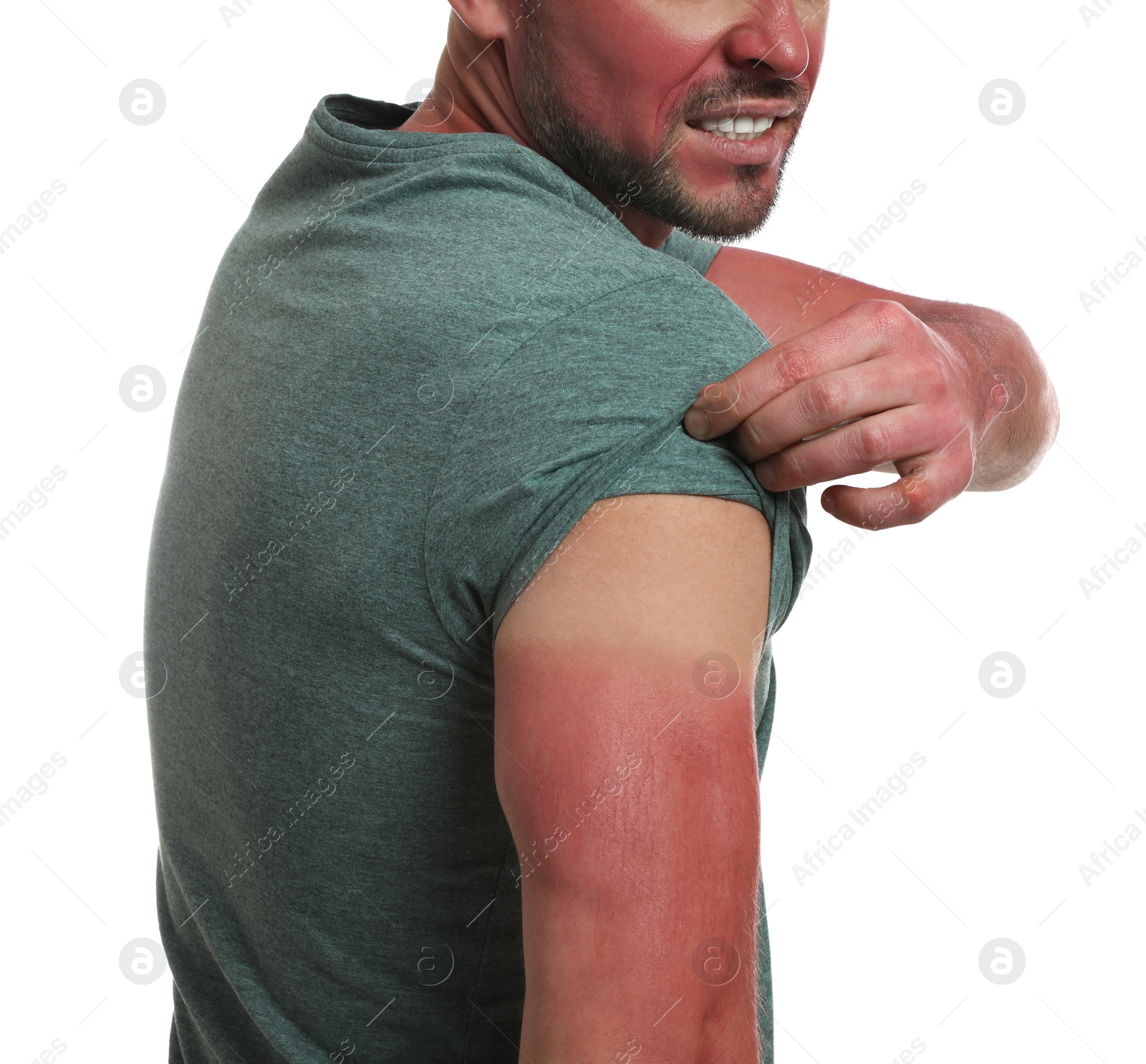 Photo of Man with sunburned skin on white background, closeup