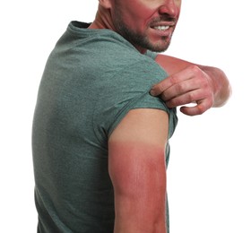 Photo of Man with sunburned skin on white background, closeup