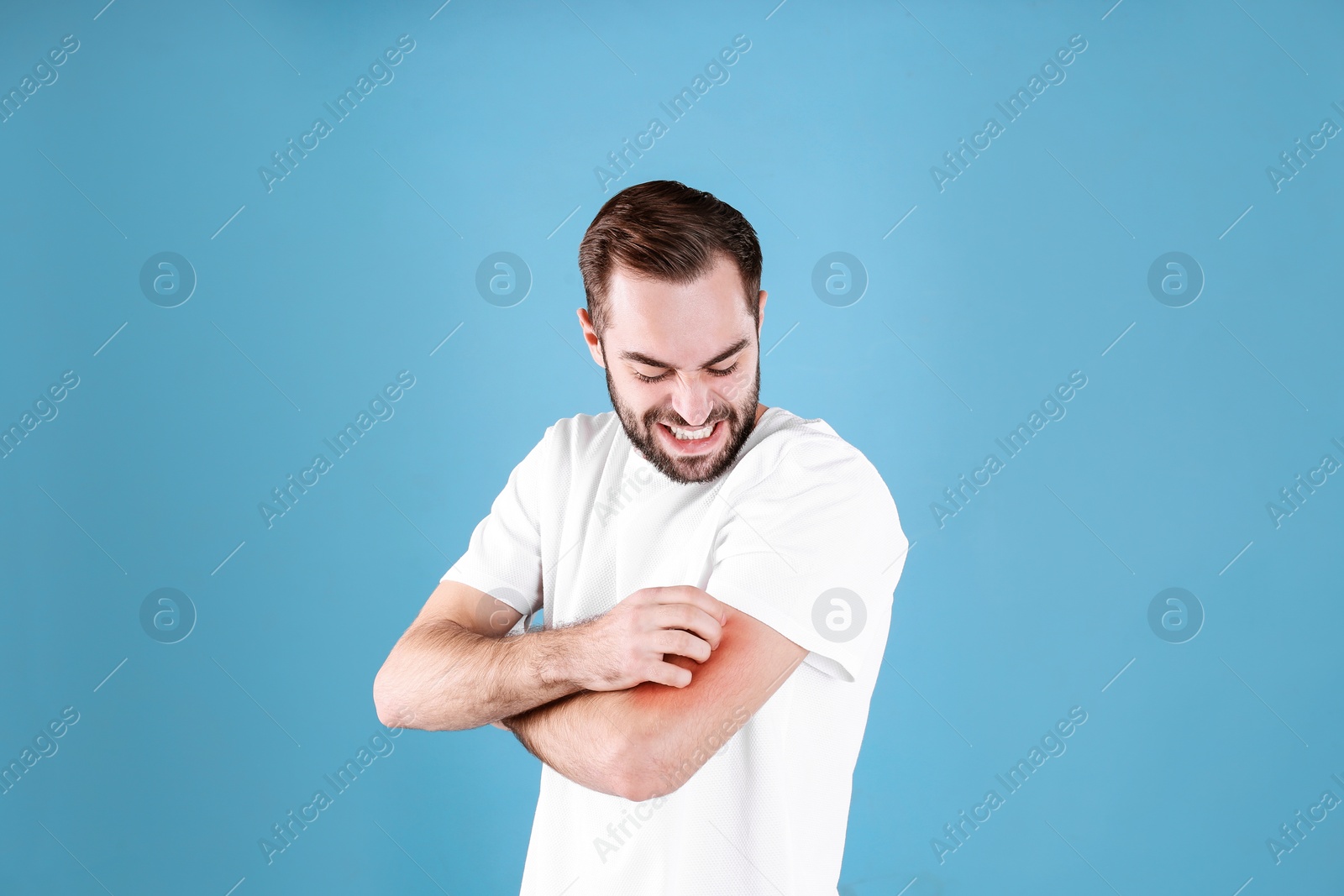 Photo of Young man scratching hand on color background. Allergies symptoms