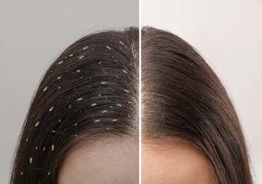 Image of Collage showing woman's hair before and after lice treatment on light background, closeup. Suffering from pediculosis