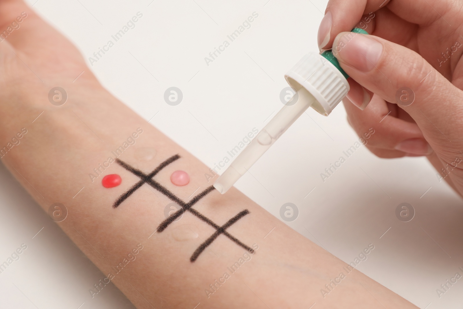 Photo of Patient undergoing skin allergy test at light table, closeup