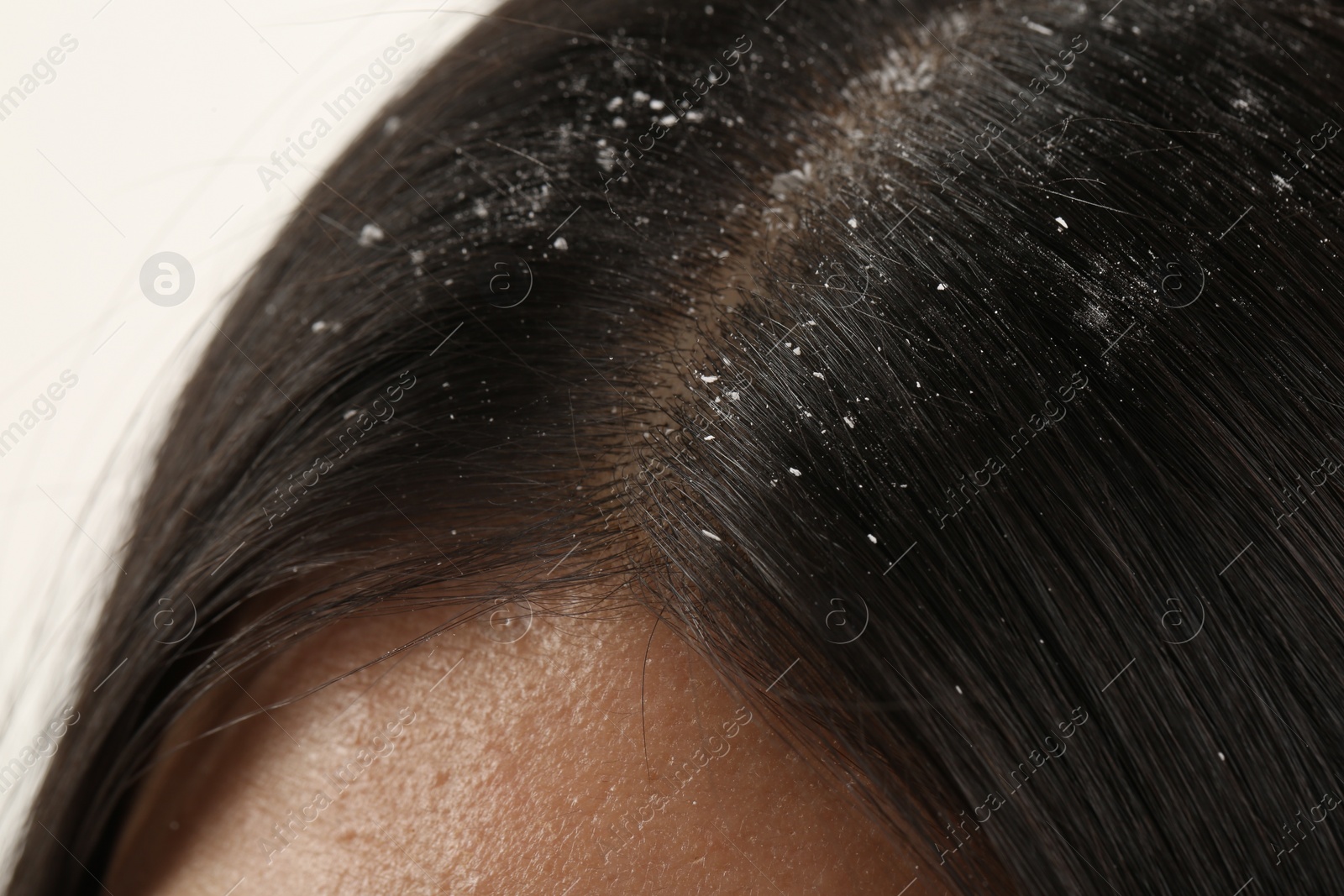 Photo of Woman with dandruff in her dark hair on white background, closeup