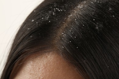 Woman with dandruff in her dark hair on white background, closeup