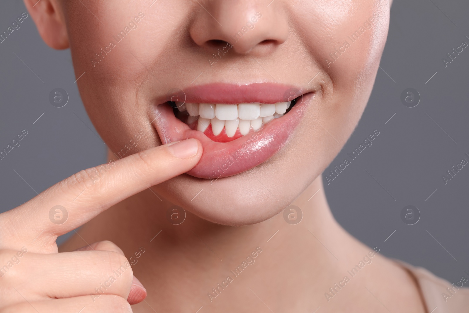 Photo of Young woman showing inflamed gums on grey background, closeup