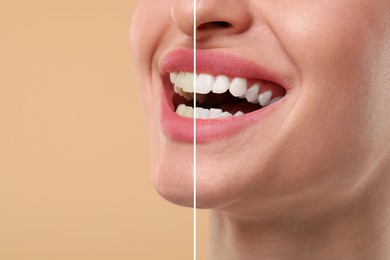 Image of Woman showing teeth before and after whitening on beige background, collage