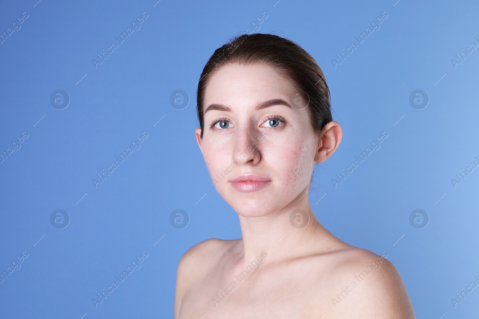 Photo of Young woman with acne problem on blue background. Space for text