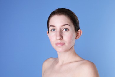 Young woman with acne problem on blue background. Space for text