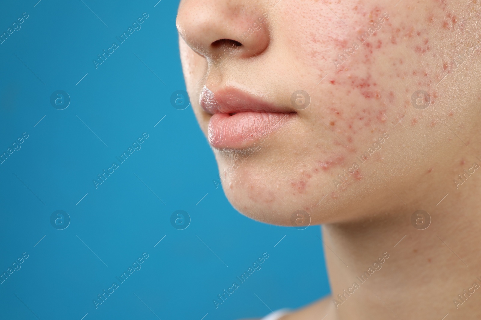 Photo of Teenage girl with acne problem on blue background, closeup