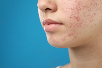 Photo of Teenage girl with acne problem on blue background, closeup