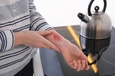 Photo of Woman with burn on her forearm near stove in kitchen, closeup