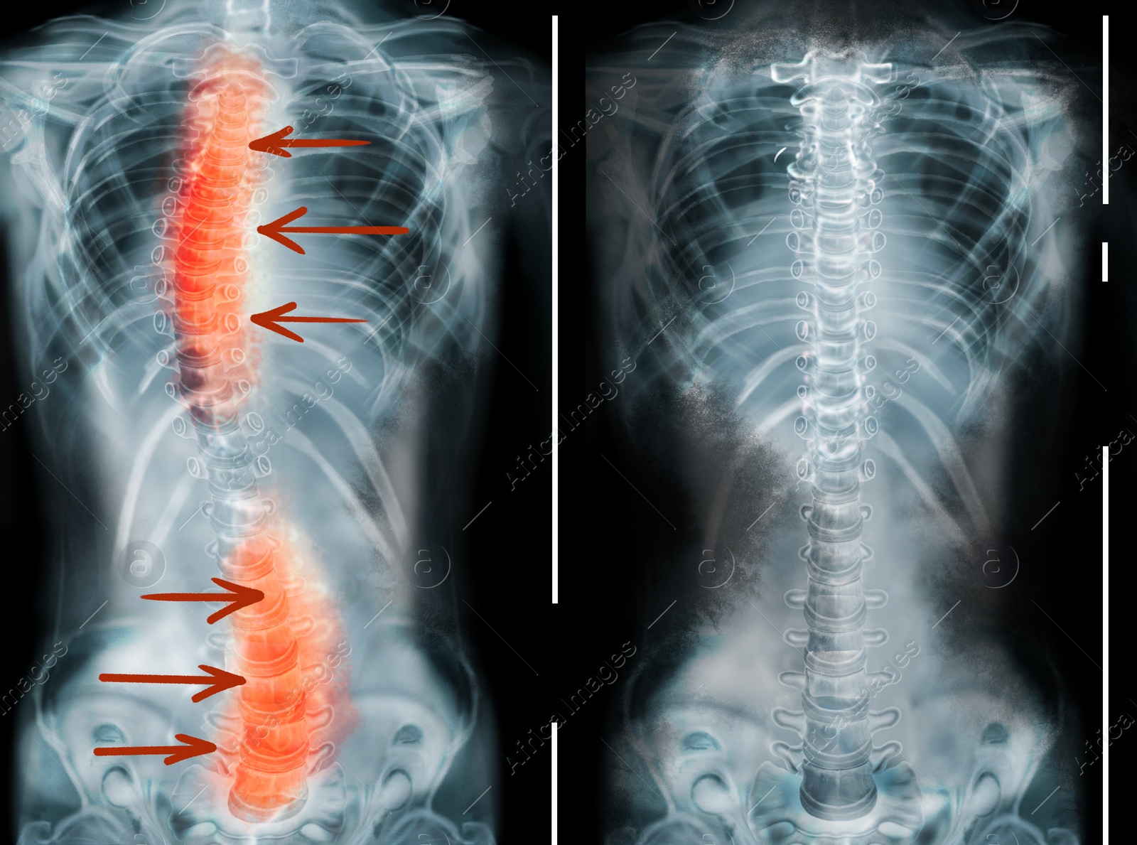 Illustration of X-rays of human normal and curved spines. Patient suffering from scoliosis